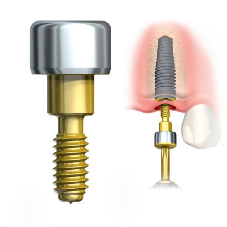 what are dental implants made of: the abutment