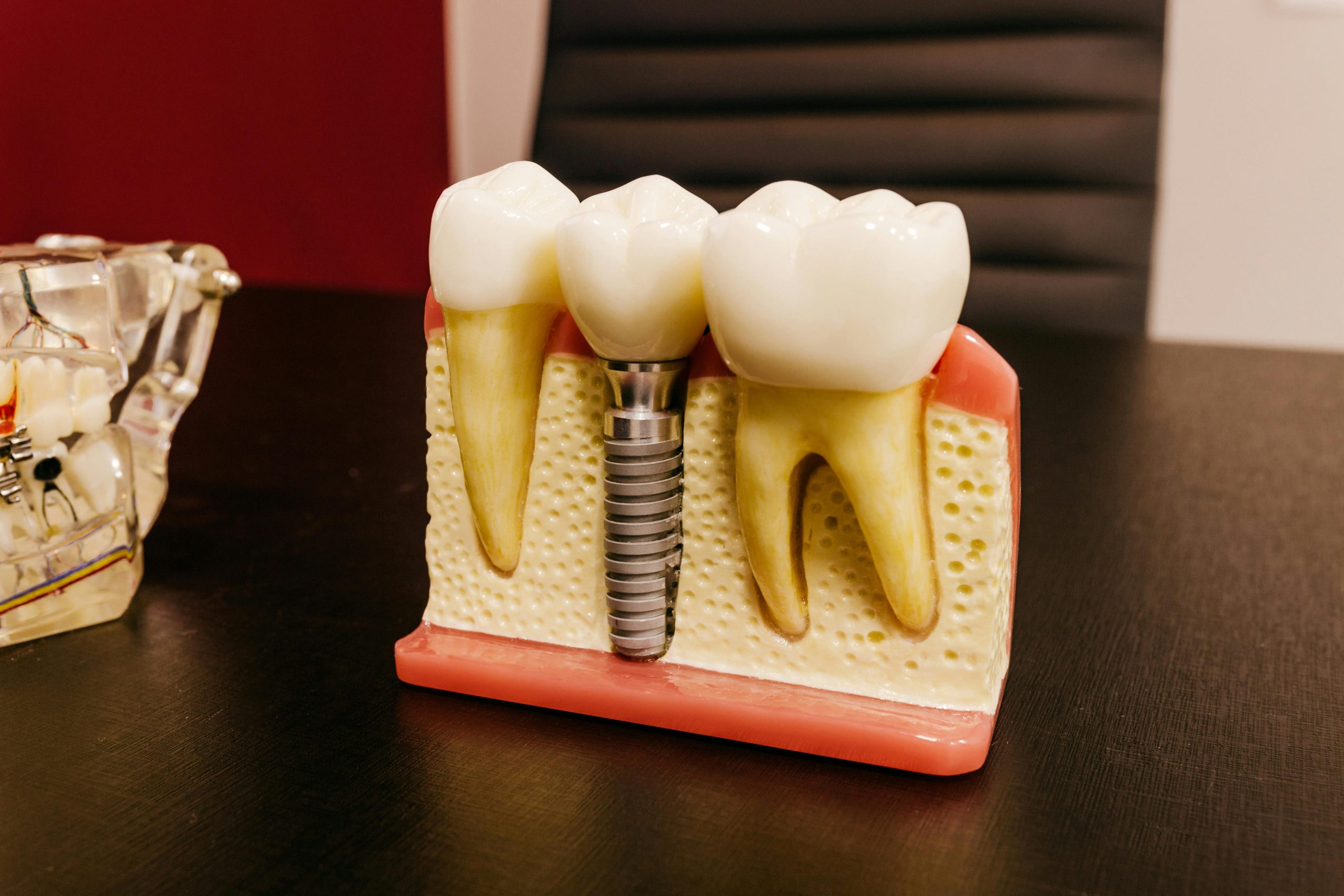 You are currently viewing All on 4 dental implants: A comprehensive guide to dental implants