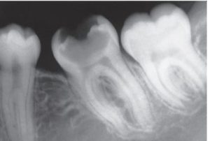 radiograph of a carious tooth