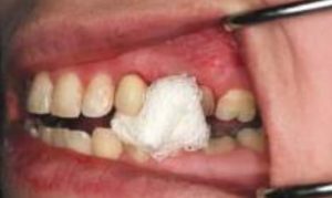 biting on cotton gauze placed after tooth extraction to prevent dry socket