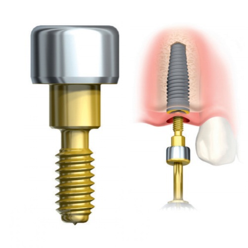 You are currently viewing What are Dental Implants Made of: The 3 main components