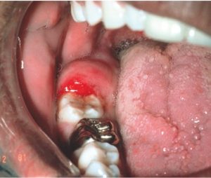 gum disease (pericoronitis) causing extreme toothache and unrest for the patient