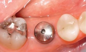 Read more about the article Tooth Implant Side Effects: 15 dangerous effects