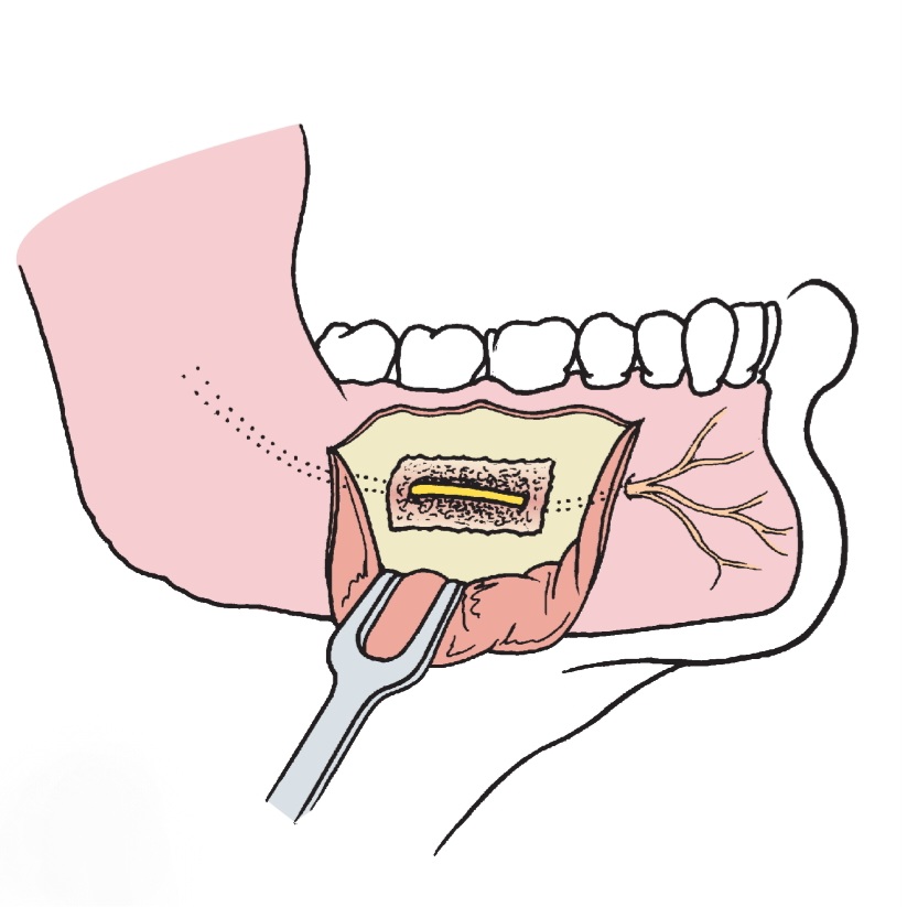 Read more about the article Kill Tooth Pain Nerve in 3 Seconds Permanently at Home: Ultimate Guide to Fast and Lasting Relief