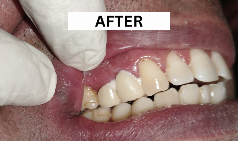 patient's mouth after the insertion of a dental bridge to improve esthetics and function