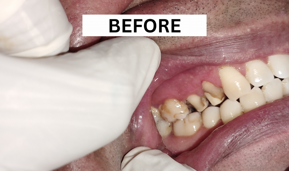 patient's teeth before the insertion of a dental bridge