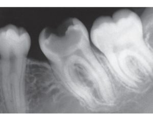 X-ray of a tooth which shows cavities in a tooth. These cavities are the reason of extreme tooth pain