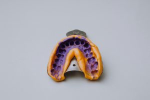 impression of a patient's mouth on which a cast will be poured and dental crown or bridge will be made