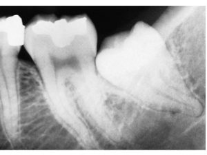 X-ray of mouth representing an impacted wisdom tooth