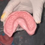 Understanding the Impression Procedure for Dental Crowns and Bridges