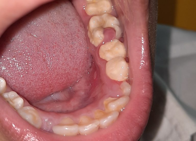 outgrowth of fibrous tissue, known as pulp polyp, in molar teeth of a patient