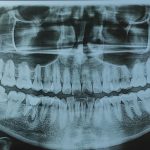 Impacted Wisdom Tooth X-Ray: Decoding Your Scan for Safer Surgery