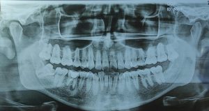 Read more about the article Impacted Wisdom Tooth X-Ray: Decoding Your Scan for Safer Surgery