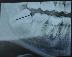 mesial impacted wisdom tooth example