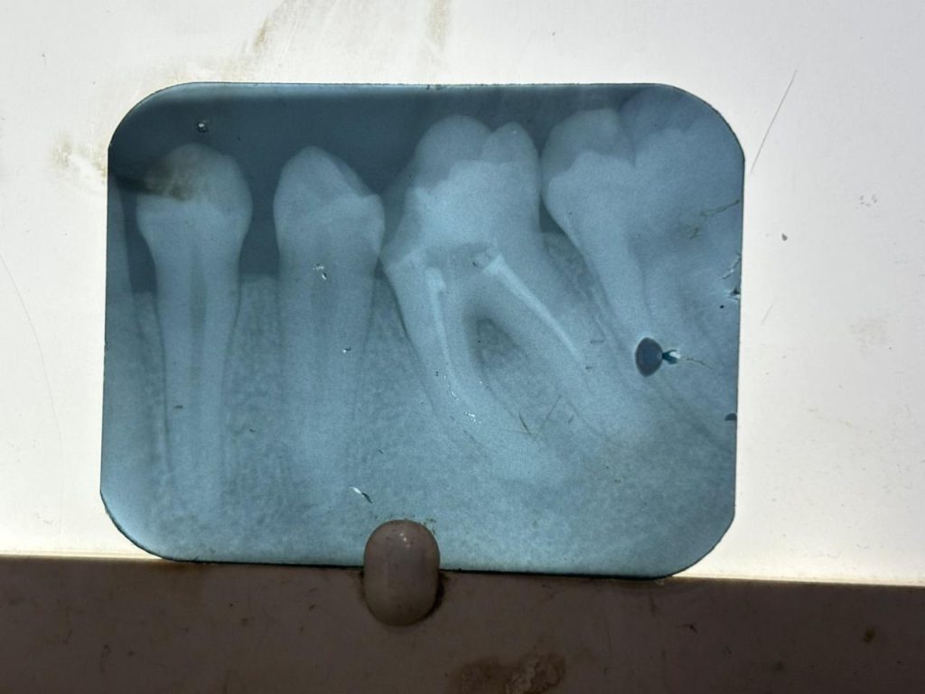 due to short gutta percha in canals, tooth hurts after root canal treatment