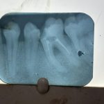 Tooth Hurts After Root Canal? Understanding Post-Treatment Pain (And When to Act)