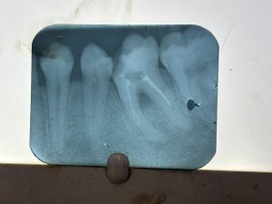 Read more about the article Tooth Hurts After Root Canal? Understanding Post-Treatment Pain (And When to Act)